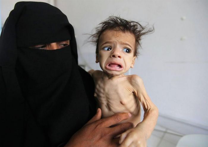 Πάνω από 8 εκ. άνθρωποι κινδυνεύουν από λιμό στην Υεμένη!