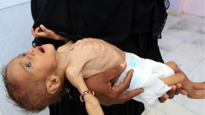 Σοκαριστικό: Ο πόλεμος στην Υεμένη σκοτώνει κάθε εννέα λεπτά και από ένα παιδί κάτω των 5 ετών!